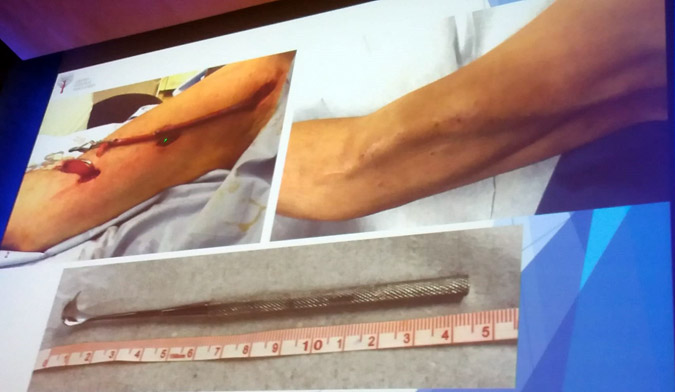 fistula de brazo
